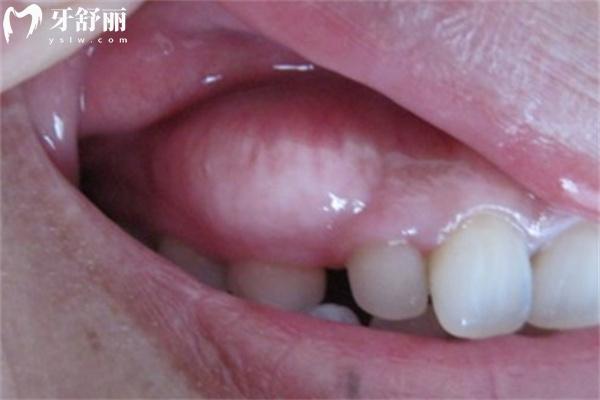 牙齦上長膿包