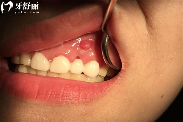 牙齦上長膿包