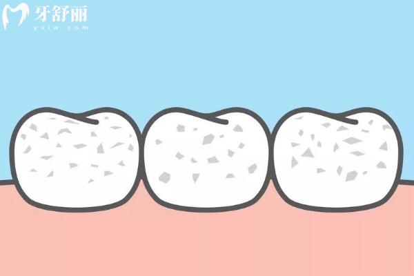 牙齒白斑