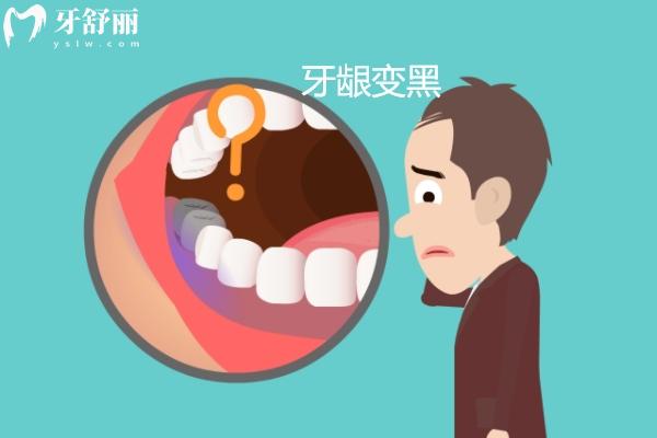 牙齦變黑怎么辦
