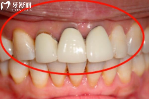 牙齦變黑怎么辦