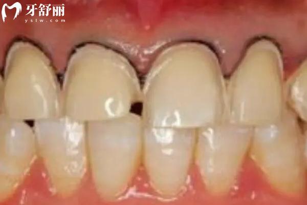 牙齦有點(diǎn)發(fā)黑是什么原因