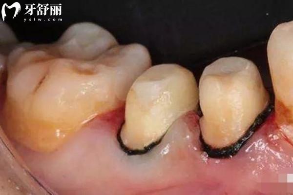 牙齦有點(diǎn)發(fā)黑是什么原因