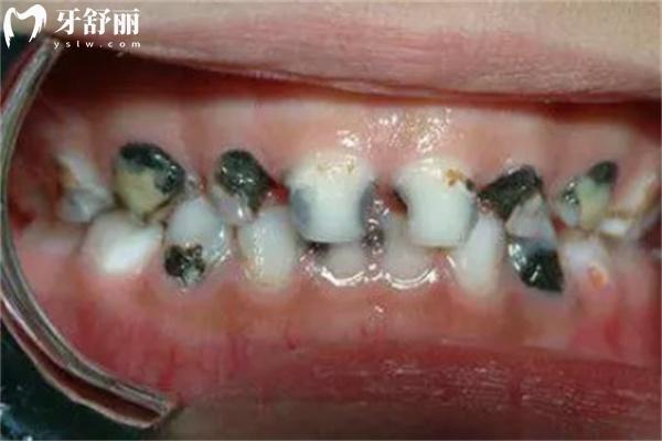 兒童黑牙齒圖片高清