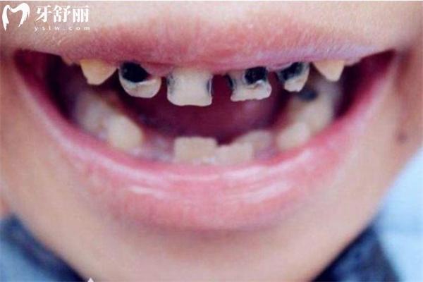 兒童黑牙齒圖片高清