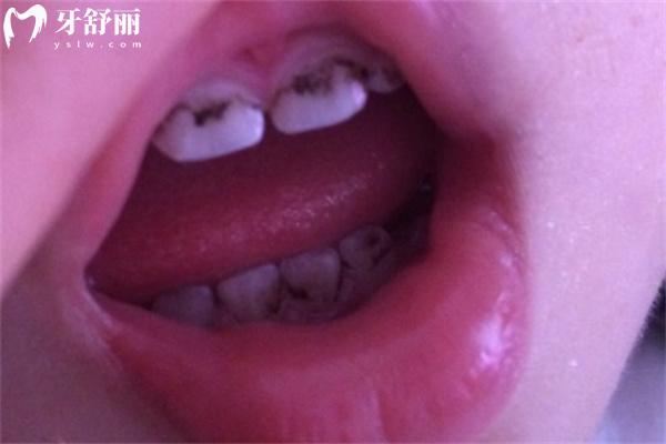 兒童黑牙齒圖片高清