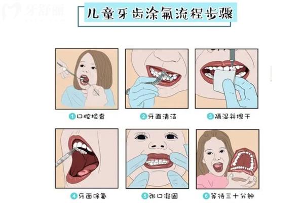 兒童牙齒涂氟