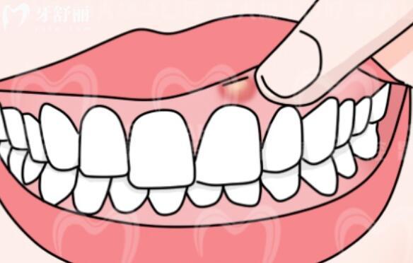 牙齦反復(fù)長(zhǎng)膿包怎么辦？探究根源解決困擾