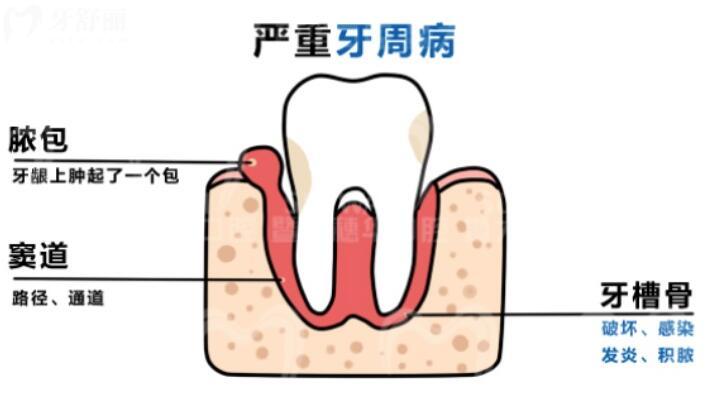 牙齦反復(fù)長(zhǎng)膿包怎么辦？探究根源解決困擾