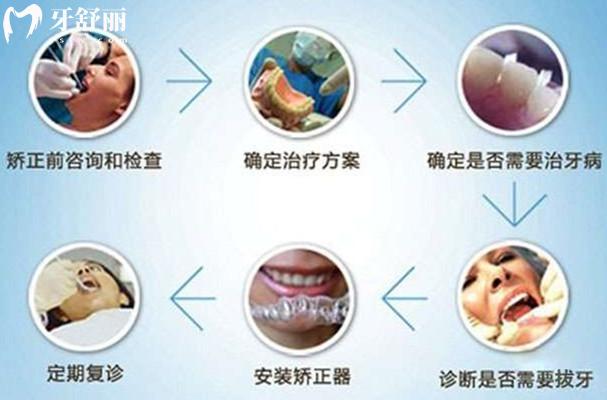 帶牙套的流程是怎么樣的