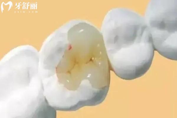 牙齒爛了個(gè)小洞，補(bǔ)了不就好了！為什么醫(yī)生非要磨那么大個(gè)洞？