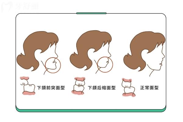 哪類人群適合做牙齒正畸？分享正畸的好處和注意事項