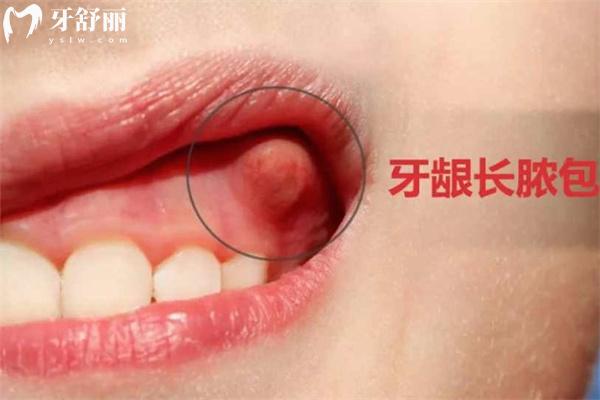 牙齦膿包怎么治療