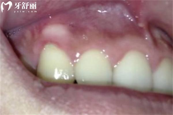 牙槽骨增生圖片