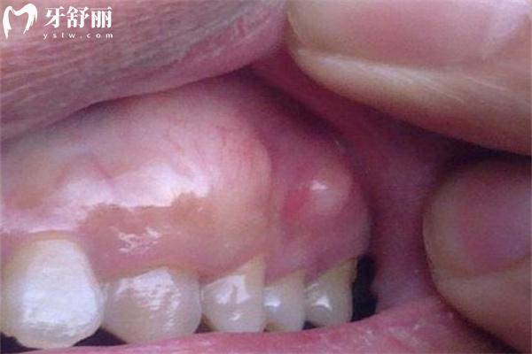 牙槽骨增生圖片