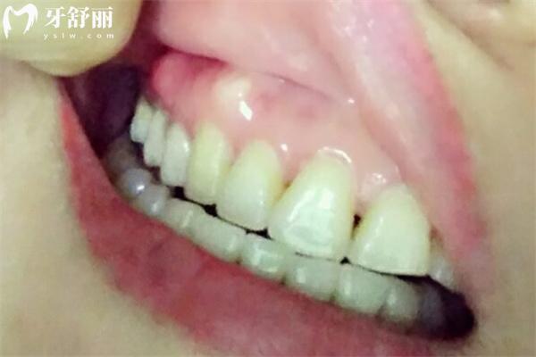 牙槽骨增生圖片