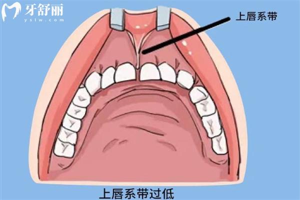 笑露牙齦與唇系帶有關(guān)系嗎？