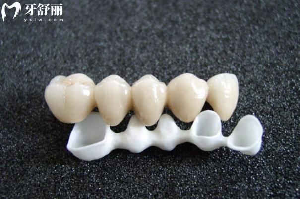 國產(chǎn)二氧化鋯全瓷牙和進口的有什么區(qū)別