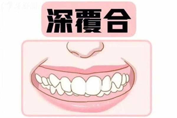 兒童深覆合矯正的必要性