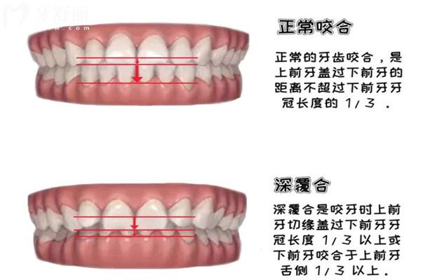 兒童深覆合矯正的必要性