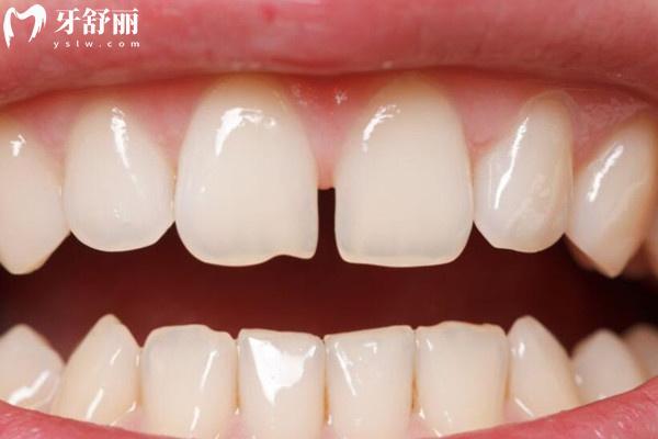 牙縫隱形術(shù)：三招效率高解決牙縫過大煩惱