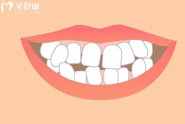 牙縫隱形術(shù)：三招效率高解決牙縫過大煩惱