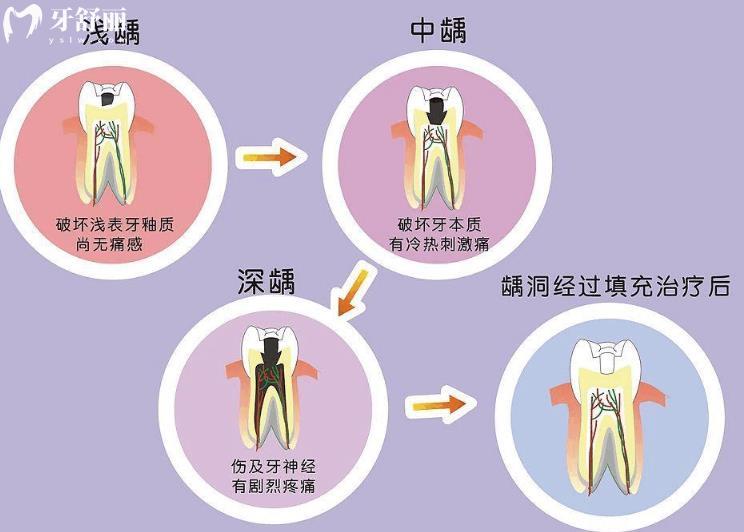 怎么判斷牙洞已經(jīng)爛到牙髓牙神經(jīng)了怎么辦
