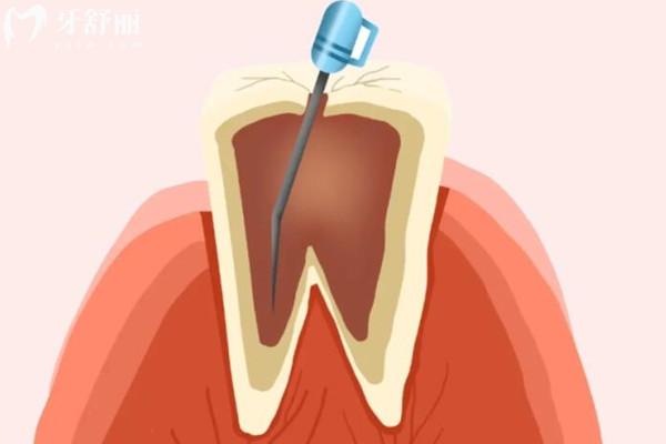 戴牙冠前為什么要磨牙呢?磨牙是保護(hù)牙齒還是傷害牙齒?