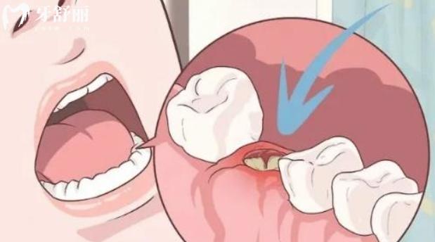 拔牙多久能排除干槽癥？來(lái)看看怎么判斷有沒有干槽癥