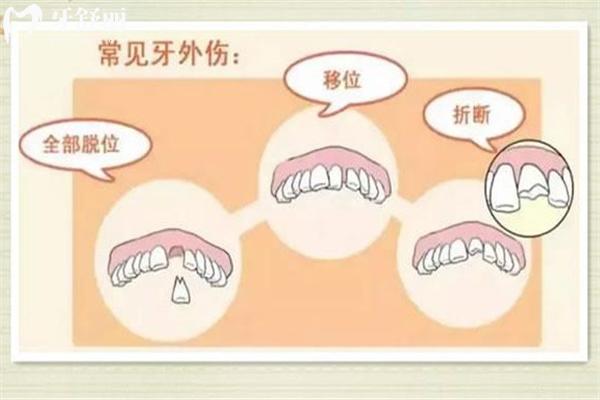 牙根吸收
