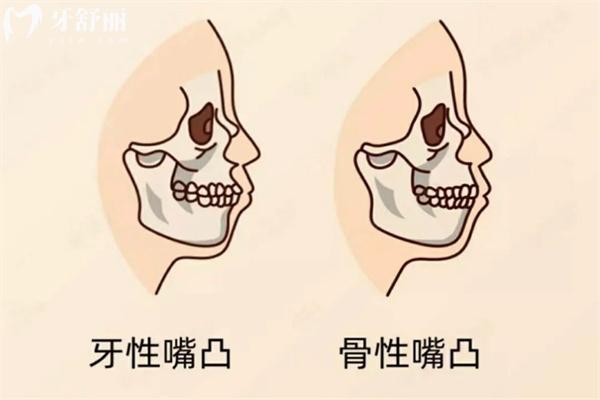 戴牙套能改善凸嘴嗎?對比牙性和骨性嘴凸情況來看便知作用如何?