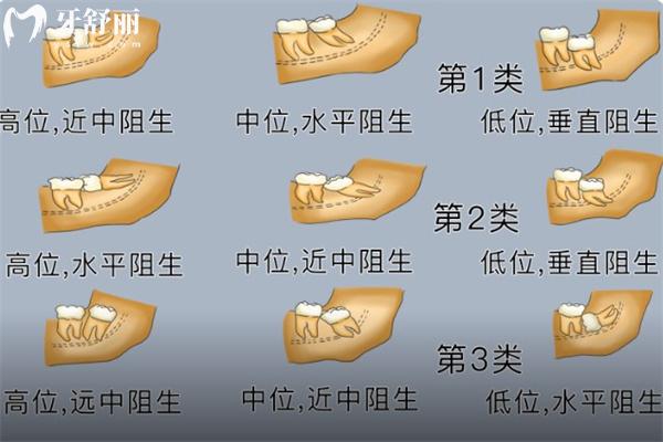 上海拔智齒多少錢(qián)一顆