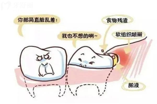 上海拔智齒多少錢(qián)一顆