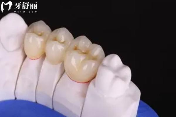 全瓷牙冠和二氧化鋯牙冠有區(qū)別嗎