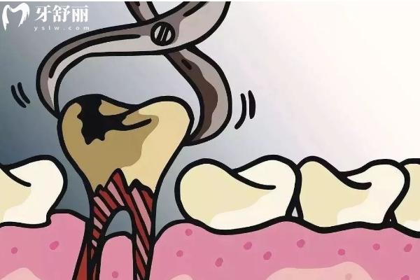 拔牙后怎么臉麻了？