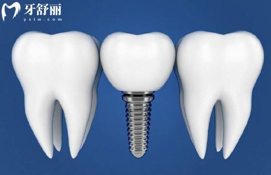 深圳正夫口腔醫(yī)生張帥玉種牙價(jià)格表