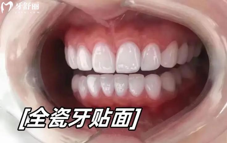 全瓷貼面