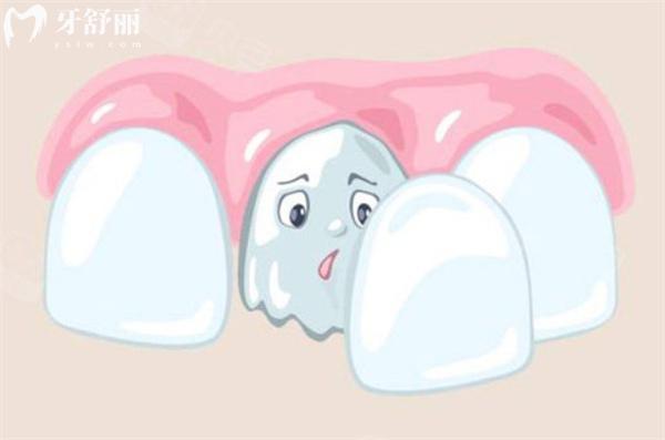 如何避免全瓷貼面對自然牙的危害