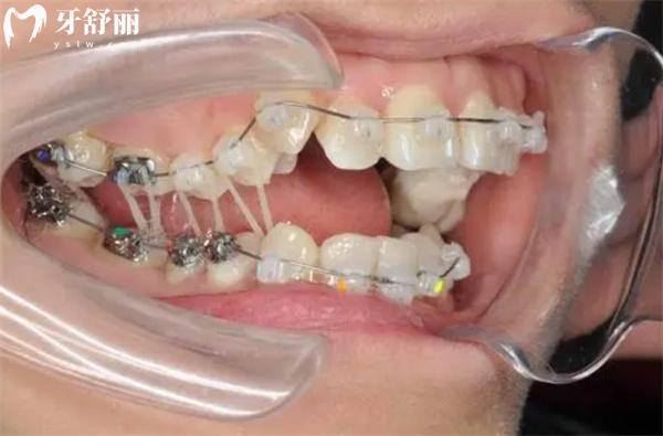 北京兒童牙齒矯正價(jià)格表