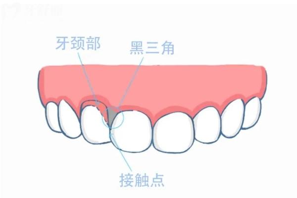 解密牙齒出現(xiàn)黑三角的原因 get解決方法+日常護(hù)牙知識