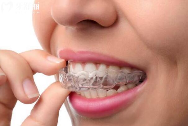 告別選擇困難癥!深度解析隱形矯正與傳統(tǒng)矯正的優(yōu)劣對(duì)比