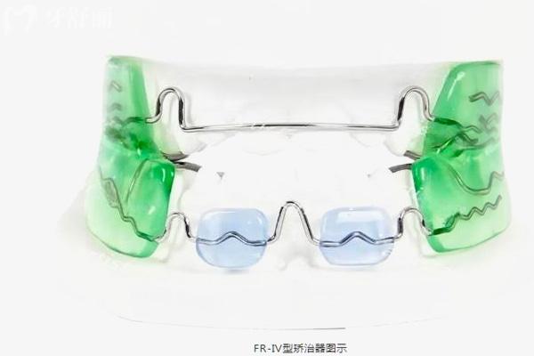 Frankel Iv矯治器.jpg