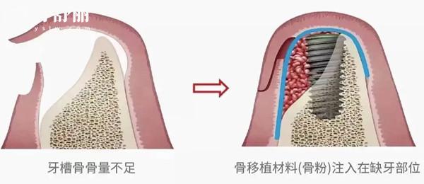 什么是牙槽骨吸收