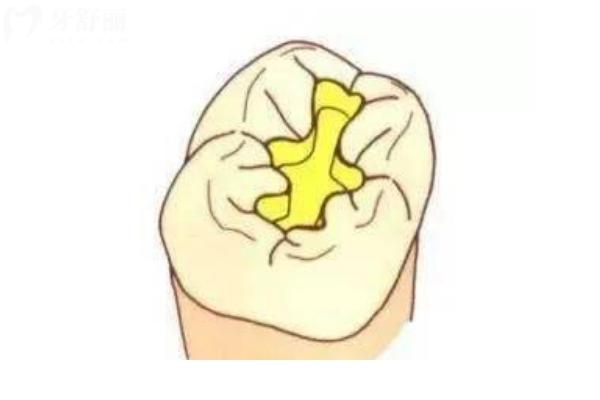蛀牙很多，可以先做牙齒矯正嗎？不可以！蛀牙會直接影響到矯正結(jié)果