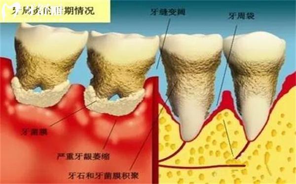 牙齒缺失十幾年了還能種植牙么?牙醫(yī)細(xì)說關(guān)鍵考量點(diǎn)