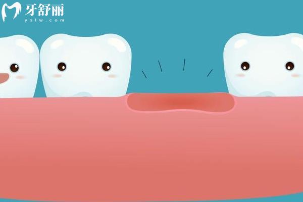 鑲牙和種植牙有什么區(qū)別哪個好