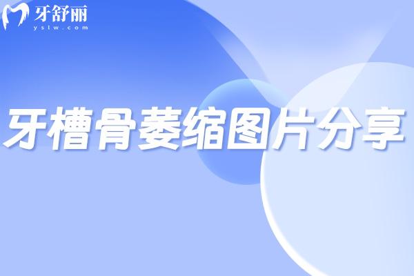 牙槽骨萎縮圖片分享