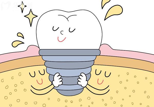 韓國(guó)登騰種植牙