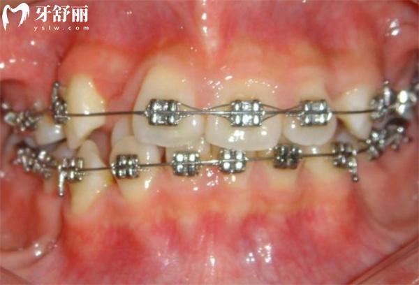 衡水哪里整牙便宜又好