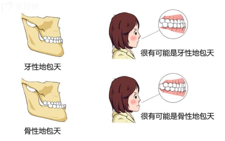 正畸正頜聯(lián)合矯正